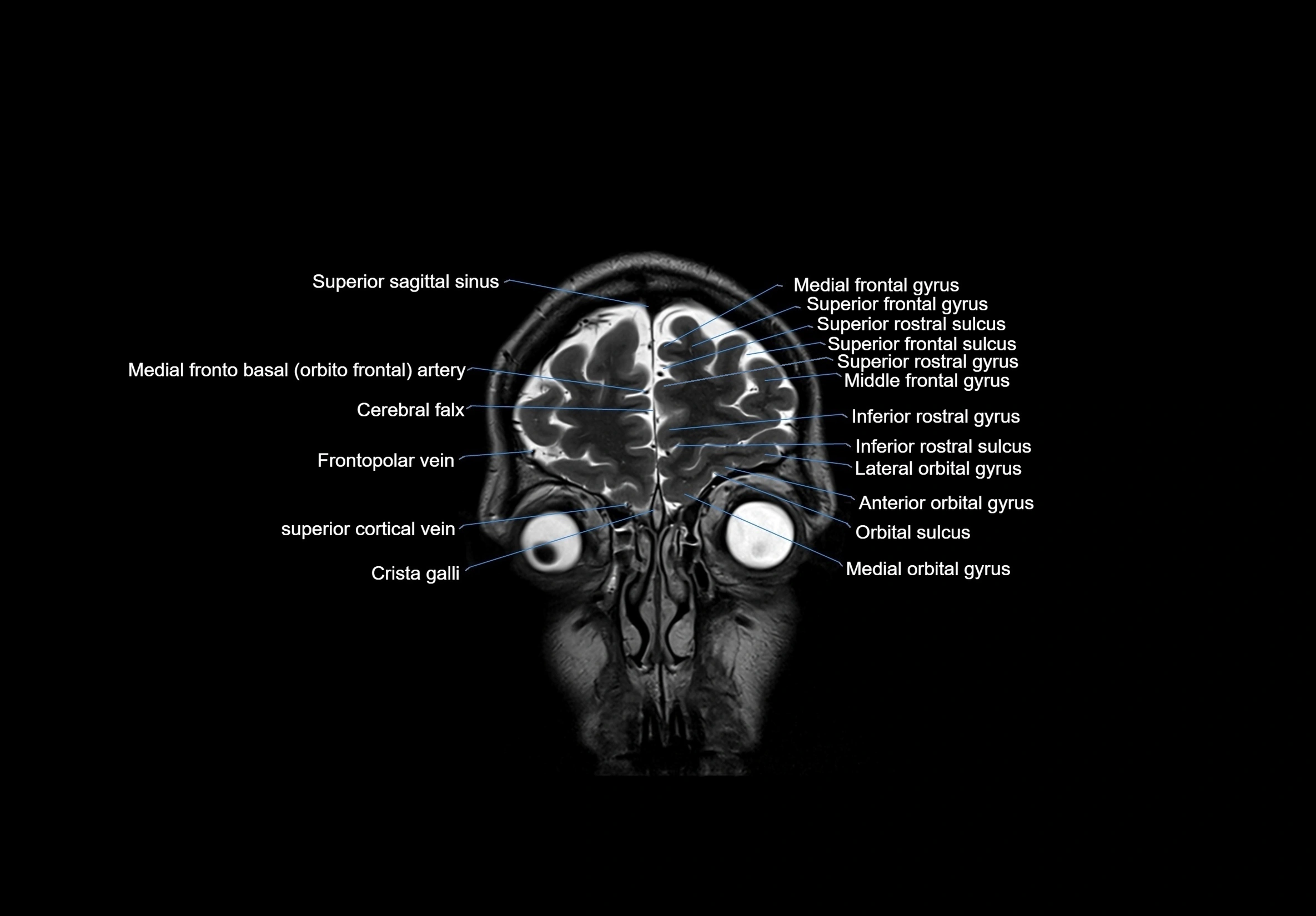 MRI Brain coronal cross sectional labelled anatomy 3T image  -img-00001-00010.webp
